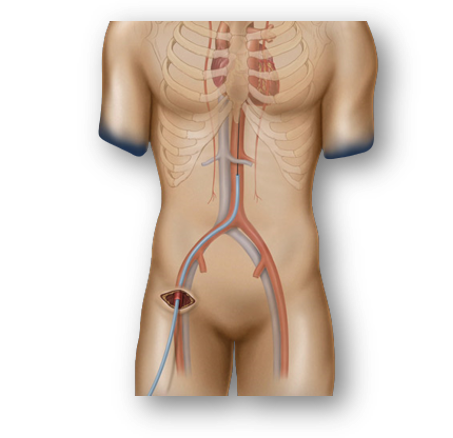 First-In-Human Trans-Septal Implantation of Saturn Mitral Valve Replacement